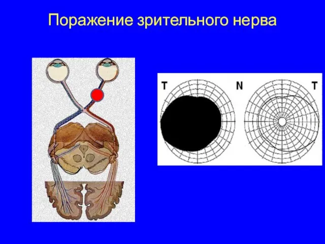 Поражение зрительного нерва