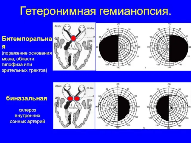 биназальная склероз внутренних сонных артерий Гетеронимная гемианопсия. Битемпоральная (поражение основания мозга, области гипофиза или зрительных трактов)