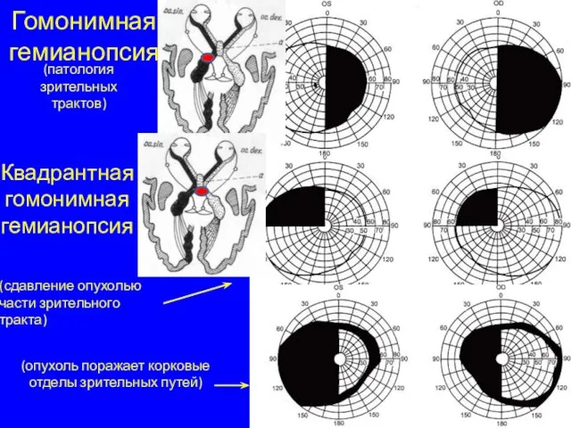 Гомонимная гемианопсия Квадрантная гомонимная гемианопсия (патология зрительных трактов) (опухоль поражает корковые отделы