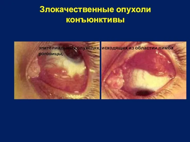 Злокачественные опухоли конъюнктивы эпителиальных опухолях, исходящих из областии лимба роговицы,