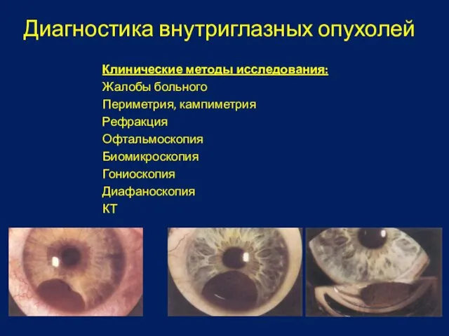 Диагностика внутриглазных опухолей Клинические методы исследования: Жалобы больного Периметрия, кампиметрия Рефракция Офтальмоскопия Биомикроскопия Гониоскопия Диафаноскопия КТ