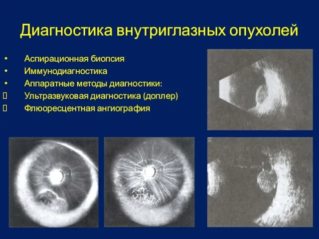 Диагностика внутриглазных опухолей Аспирационная биопсия Иммунодиагностика Аппаратные методы диагностики: Ультразвуковая диагностика (доплер) Флюоресцентная ангиография