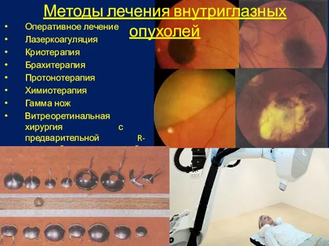 Методы лечения внутриглазных опухолей Оперативное лечение Лазеркоагуляция Криотерапия Брахитерапия Протонотерапия Химиотерапия Гамма