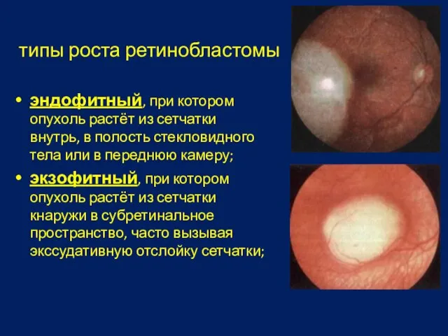 типы роста ретинобластомы эндофитный, при котором опухоль растёт из сетчатки внутрь, в