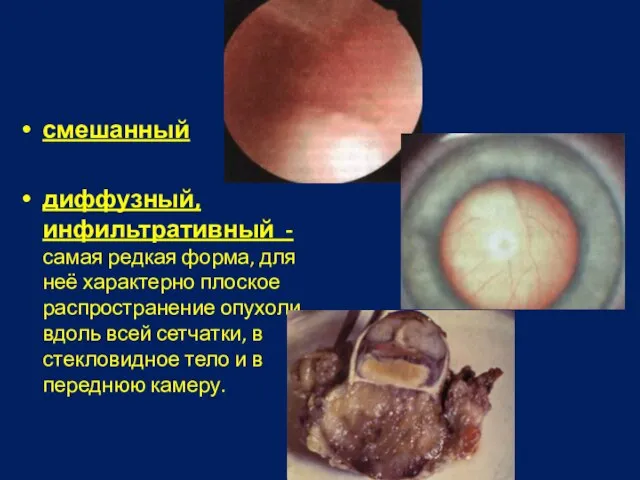 смешанный диффузный, инфильтративный - самая редкая форма, для неё характерно плоское распространение