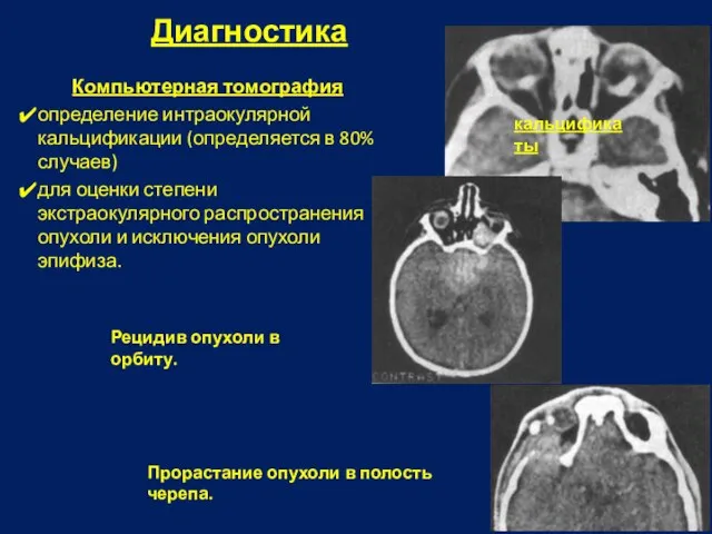 Диагностика Компьютерная томография определение интраокулярной кальцификации (определяется в 80% случаев) для оценки