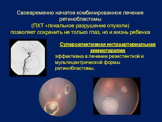 Своевременно начатое комбинированное лечение ретинобластомы (ПХТ +локальное разрушение опухоли) позволяет сохранить не