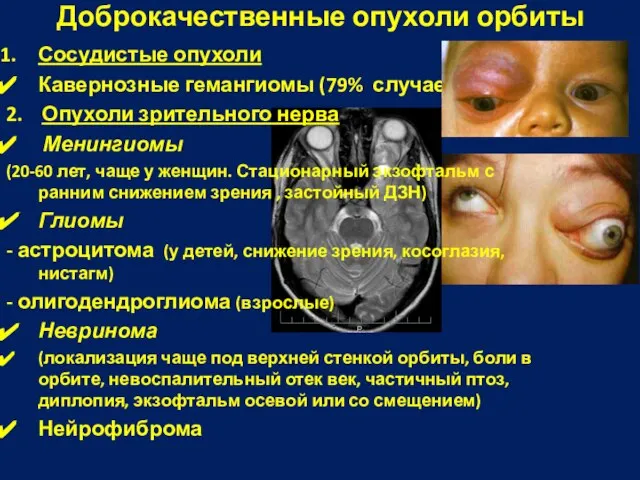 Сосудистые опухоли Кавернозные гемангиомы (79% случаев); 2. Опухоли зрительного нерва Менингиомы (20-60