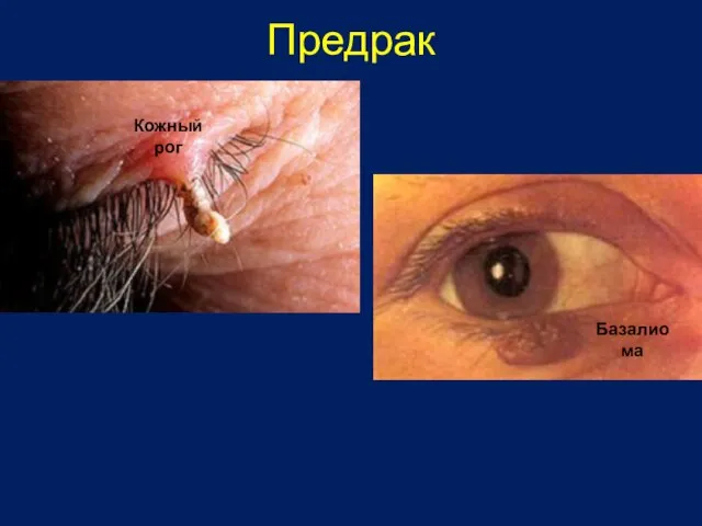 Предрак Кожный рог Базалиома