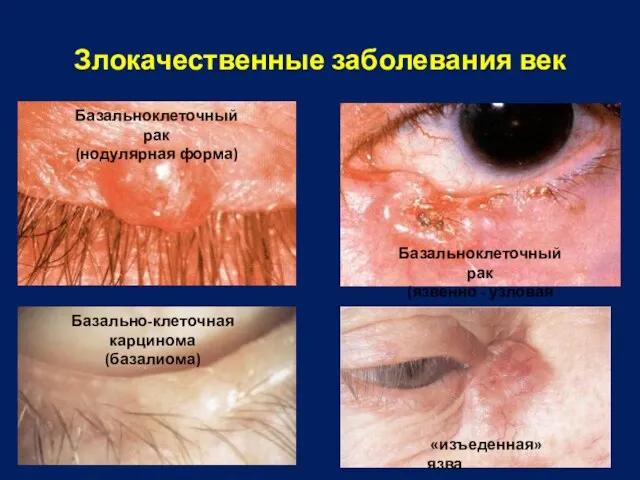 Злокачественные заболевания век Базальноклеточный рак (нодулярная форма) Базальноклеточный рак (язвенно - узловая