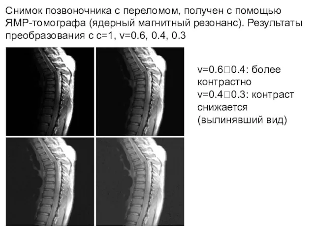 Снимок позвоночника с переломом, получен с помощью ЯМР-томографа (ядерный магнитный резонанс). Результаты