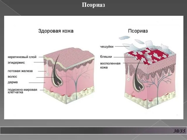 30/35 Псориаз