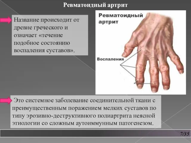 7/35 Ревматоидный артрит Название происходит от древне греческого и означает «течение подобное