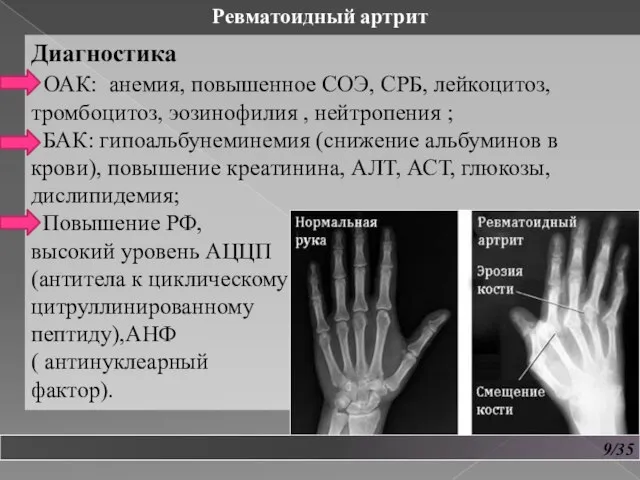 9/35 Ревматоидный артрит Диагностика ОАК: анемия, повышенное СОЭ, СРБ, лейкоцитоз, тромбоцитоз, эозинофилия