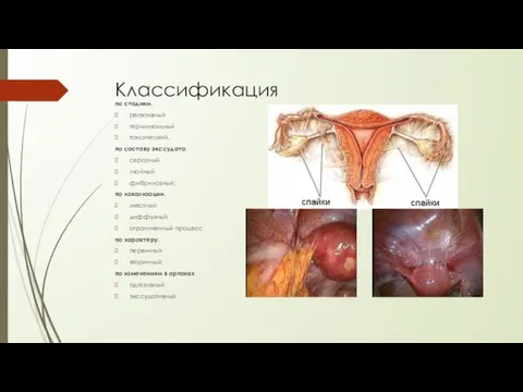 Классификация по стадиям. реактивный терминальный токсический. по составу экссудата. серозный гнойный фибринозный;