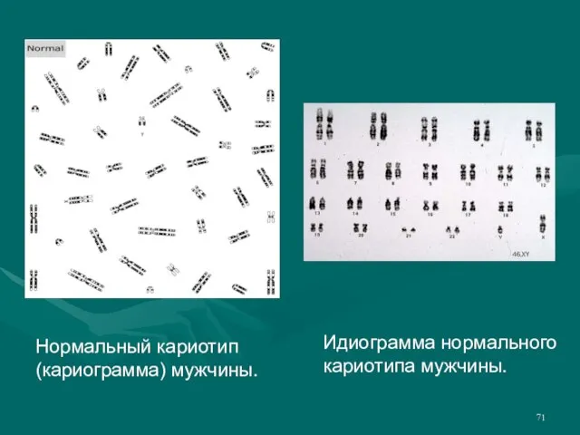 Нормальный кариотип (кариограмма) мужчины. Идиограмма нормального кариотипа мужчины.