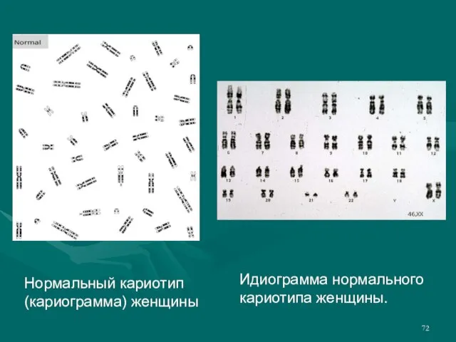 Нормальный кариотип (кариограмма) женщины Идиограмма нормального кариотипа женщины.