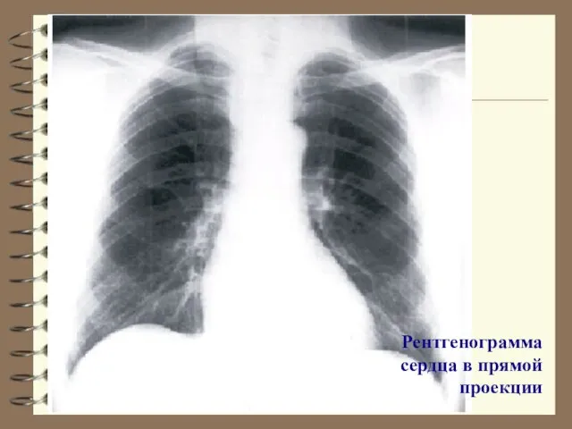 Рентгенограмма сердца в прямой проекции