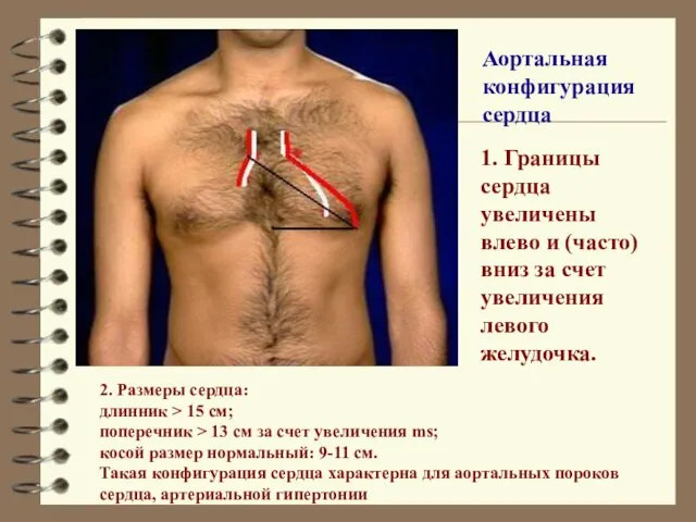 2. Размеры сердца: длинник > 15 см; поперечник > 13 см за