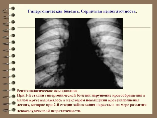 Гипертоническая болезнь. Сердечная недостаточность. Рентгенологическое исследование При 1-й стадии гипертонической болезни нарушение