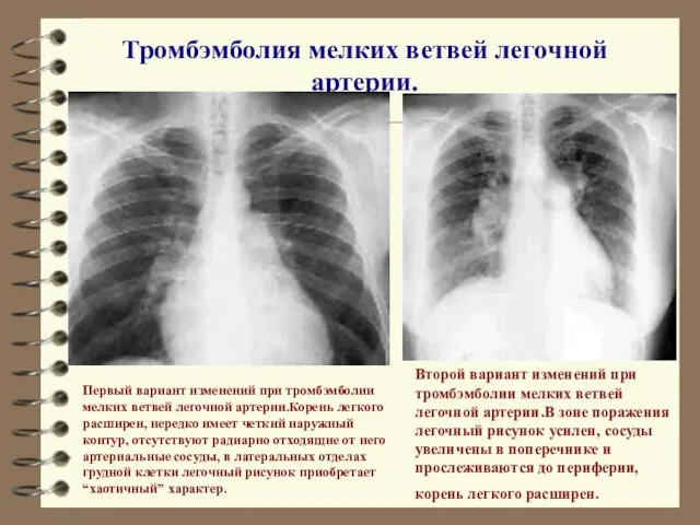 Тромбэмболия мелких ветвей легочной артерии. Первый вариант изменений при тромбэмболии мелких ветвей