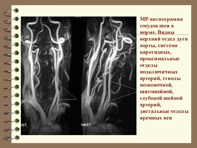 МР-ангиограмма сосудов шеи в норме. Видны верхний отдел дуги аорты, система каротидных,