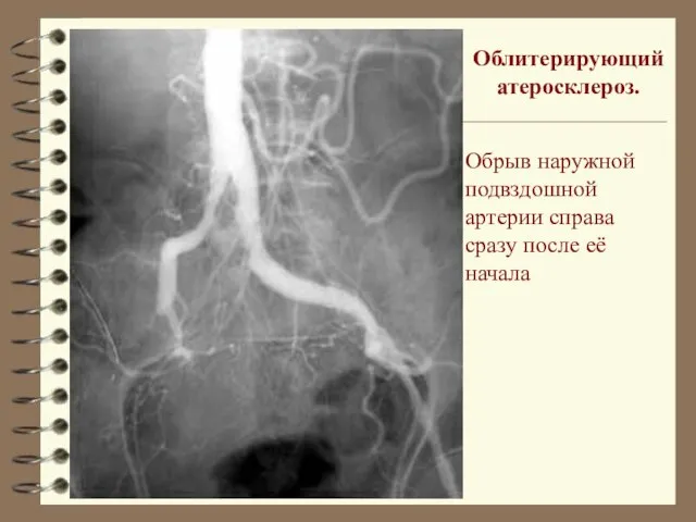 Облитерирующий атеросклероз. Обрыв наружной подвздошной артерии справа сразу после её начала