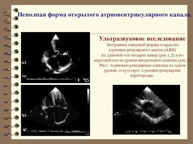 Ультразвуковое исследование Эхограммы неполной формы открытого атриовентрикулярного канала (АВК) по длинной оси