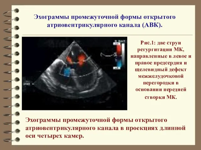 Эхограммы промежуточной формы открытого атриовентрикулярного канала (АВК). Эхограммы промежуточной формы открытого атриовентрикулярного