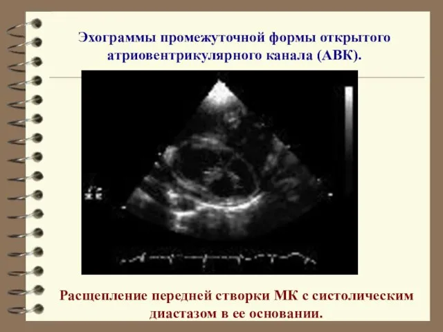 Эхограммы промежуточной формы открытого атриовентрикулярного канала (АВК). Расщепление передней створки МК с