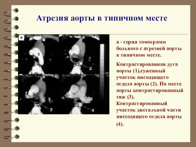 Атрезия аорты в типичном месте а - серия томограмм больного с атрезией