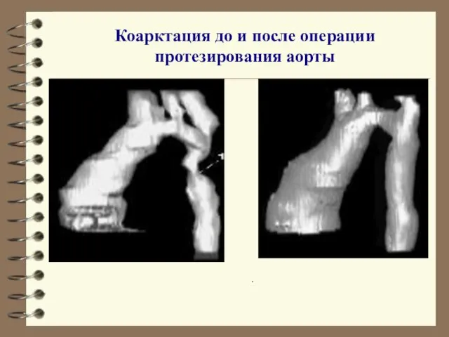 Коарктация до и после операции протезирования аорты .
