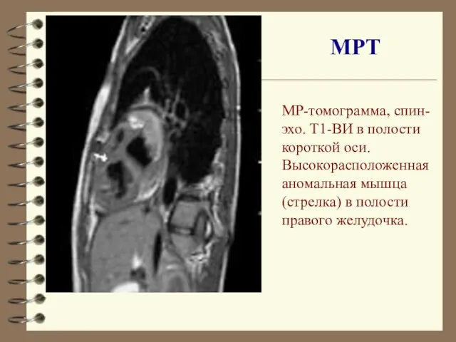 МР-томограмма, спин-эхо. Т1-ВИ в полости короткой оси. Высокорасположенная аномальная мышца (стрелка) в полости правого желудочка. МРТ