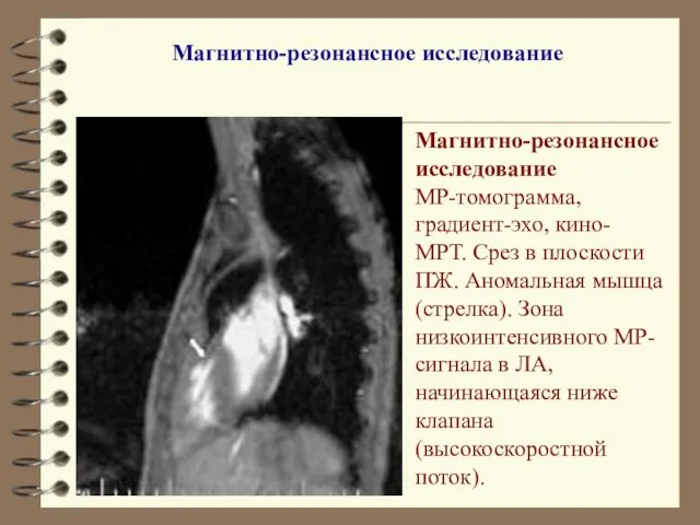 Магнитно-резонансное исследование МР-томограмма, градиент-эхо, кино-МРТ. Срез в плоскости ПЖ. Аномальная мышца (стрелка).