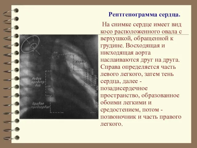 Рентгенограмма сердца. На снимке сердце имеет вид косо расположенного овала с верхушкой,