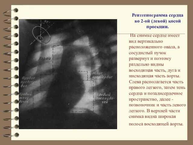 Рентгенограмма сердца во 2-ой (левой) косой проекции. На снимке сердце имеет вид