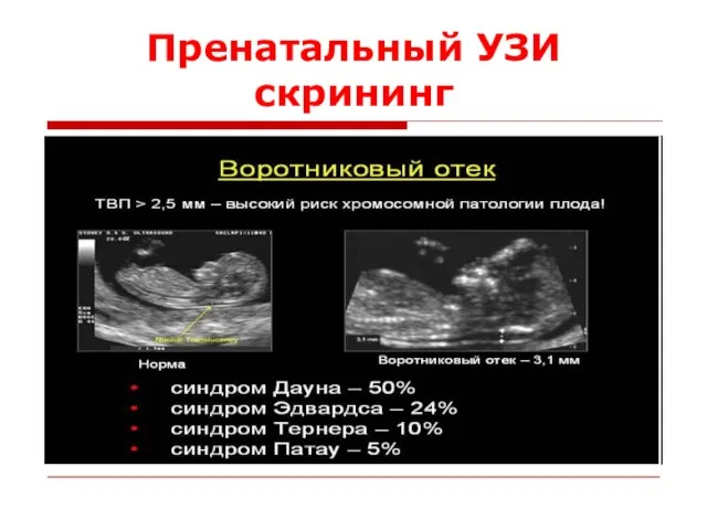 Пренатальный УЗИ скрининг