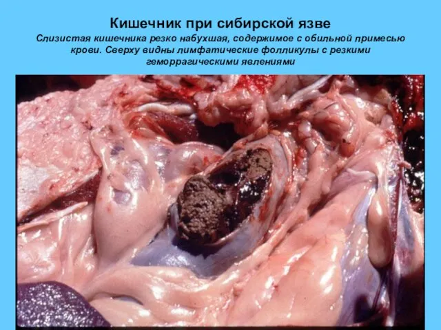 Кишечник при сибирской язве Слизистая кишечника резко набухшая, содержимое с обильной примесью