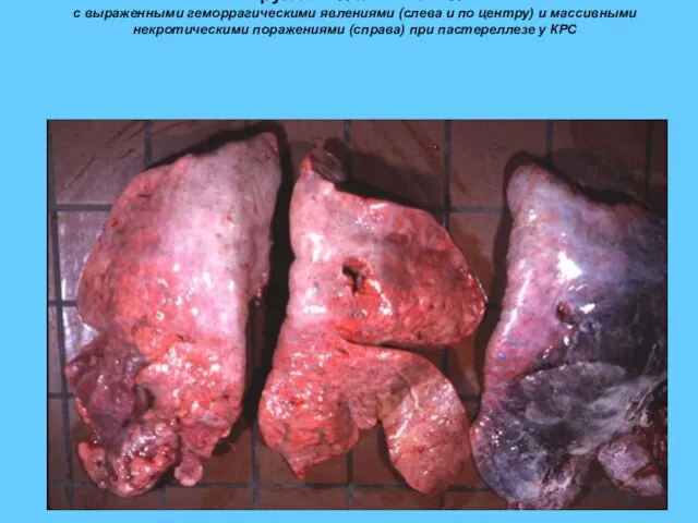 Крупозная пневмония с выраженными геморрагическими явлениями (слева и по центру) и массивными