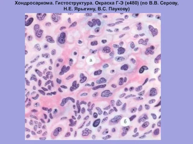 Хондросаркома. Гистоструктура. Окраска Г-Э (х480) (по В.В. Серову, Н.Е. Ярыгину, В.С. Паукову)