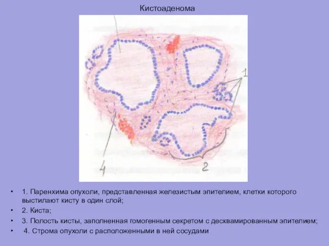 Кистоаденома 1. Паренхима опухоли, представленная железистым эпителием, клетки которого выстилают кисту в