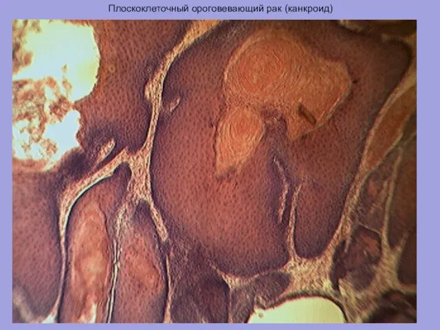 Плоскоклеточный ороговевающий рак (канкроид)