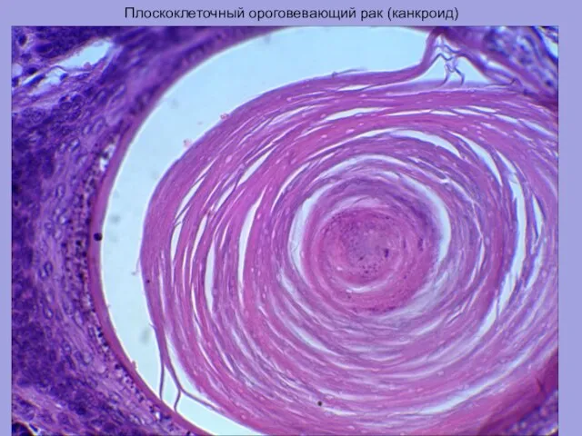 Плоскоклеточный ороговевающий рак (канкроид)