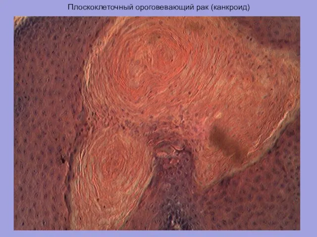 Плоскоклеточный ороговевающий рак (канкроид)