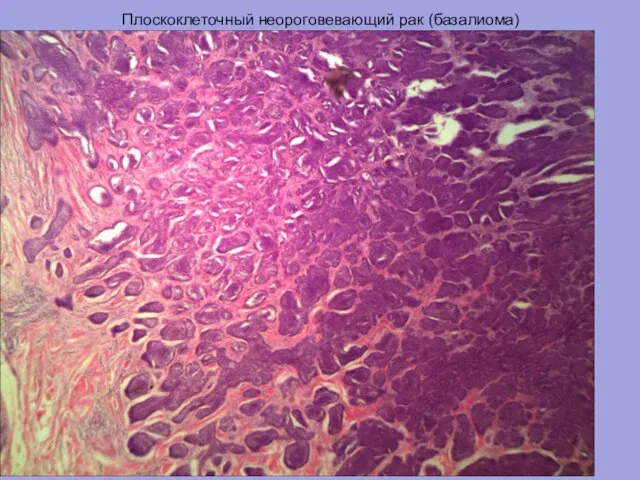 Плоскоклеточный неороговевающий рак (базалиома)