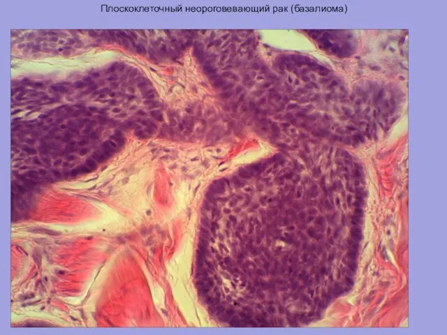 Плоскоклеточный неороговевающий рак (базалиома)