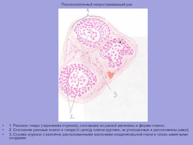 Плоскоклеточный неороговевающий рак 1. Раковое гнездо (паренхима опухоли), состоящее из разной величины