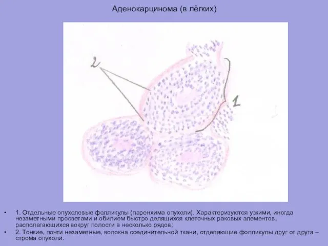 Аденокарцинома (в лёгких) 1. Отдельные опухолевые фолликулы (паренхима опухоли). Характеризуются узкими, иногда
