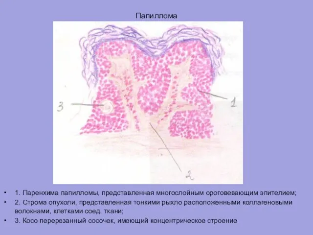 Папиллома 1. Паренхима папилломы, представленная многослойным ороговевающим эпителием; 2. Строма опухоли, представленная