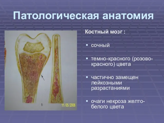 Патологическая анатомия Костный мозг : сочный темно-красного (розово-красного) цвета частично замещен лейкозными